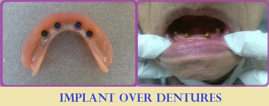 What to expect with immediate dentures
