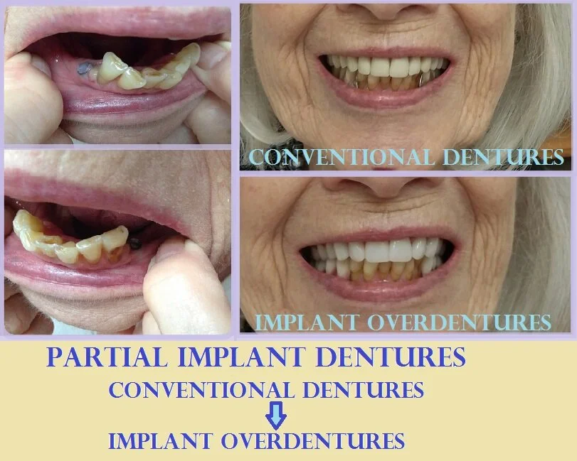 Implant retained dentures for stability