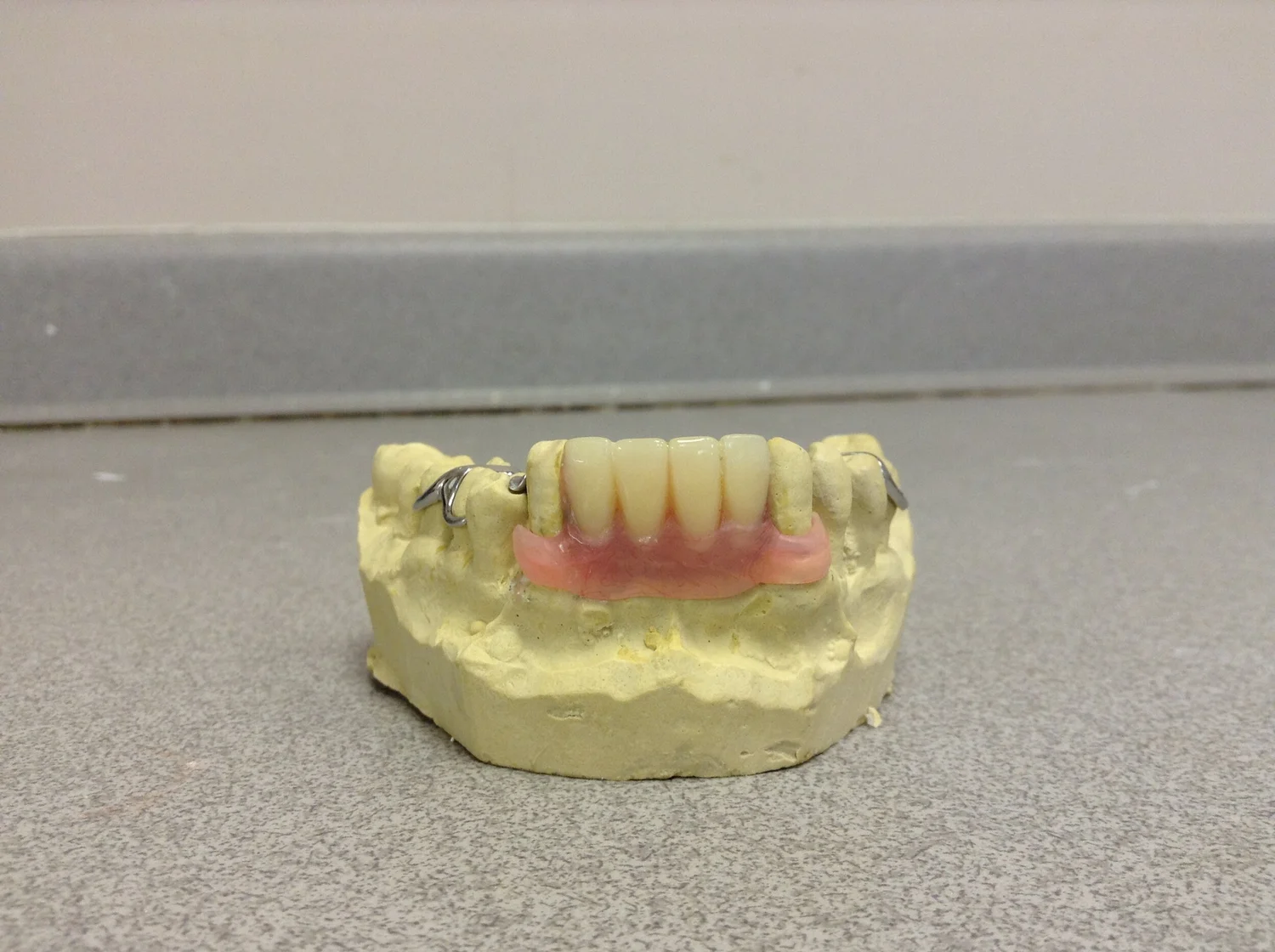 Cast partial denture at our Burnaby denture clinic