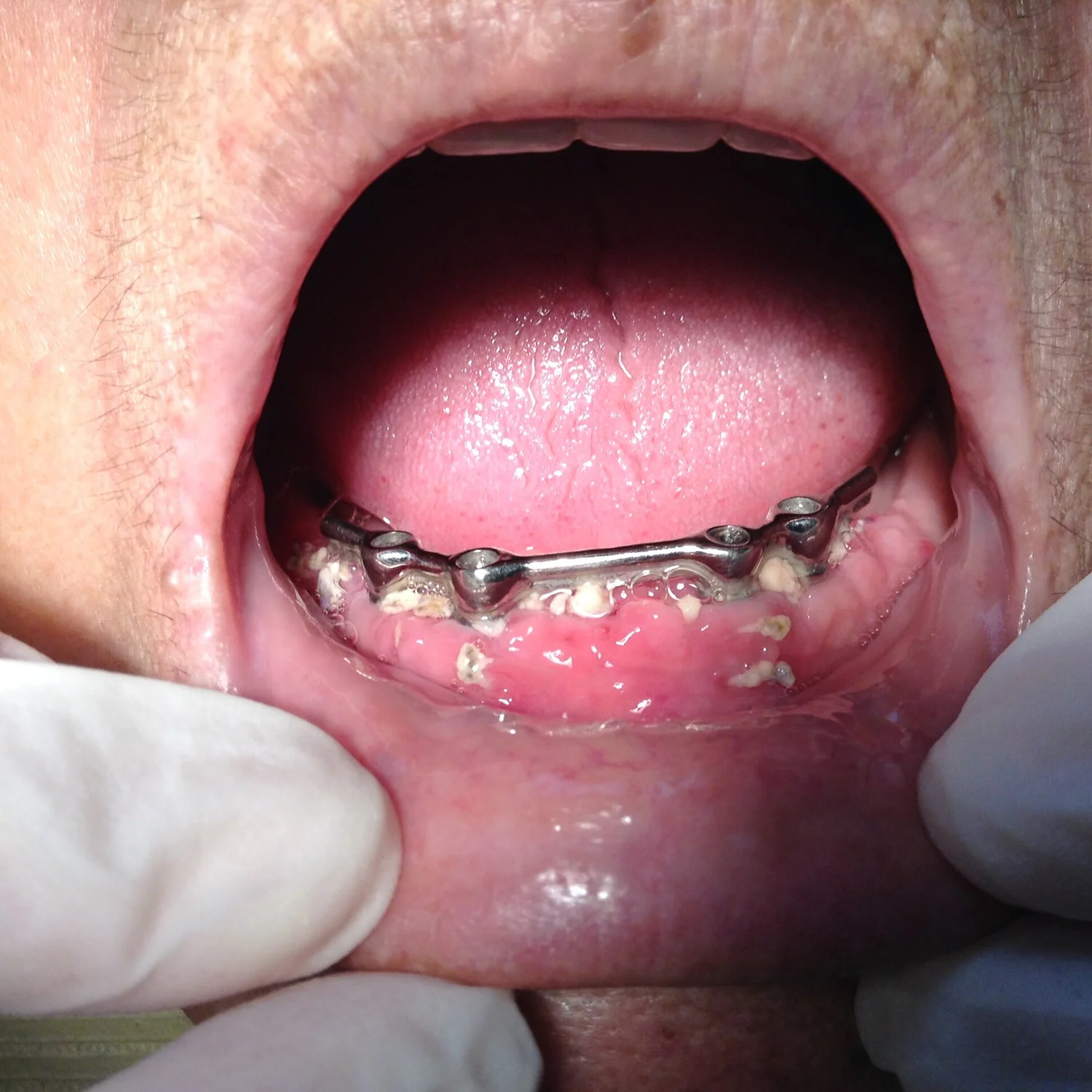 Implant over denture treatment in Vancouver and Burnaby