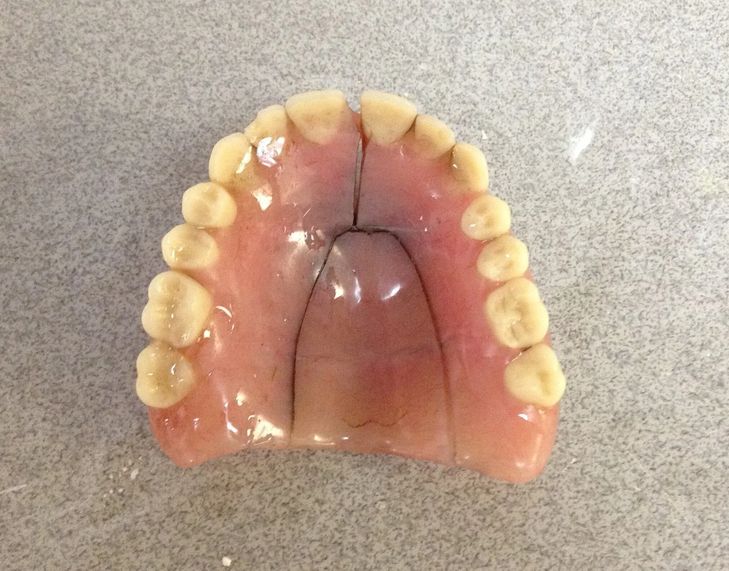 Fast denture repair service in Vancouver and Burnaby